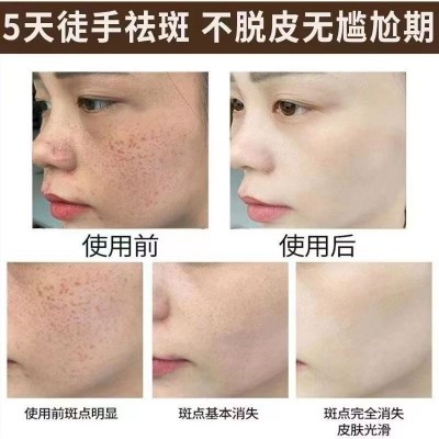 五天徒手清班术海绵微针霜涂抹揉斑术斑后保养修复控色美白祛斑霜图3