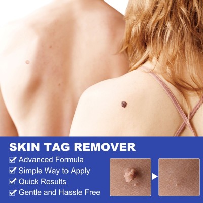 ELAIMEI 简易疣子去除皮肤工具Skin Tag Removal Kit图2